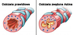 astma oskrzela